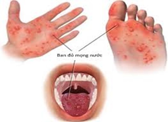 Bệnh Tay chân miệng